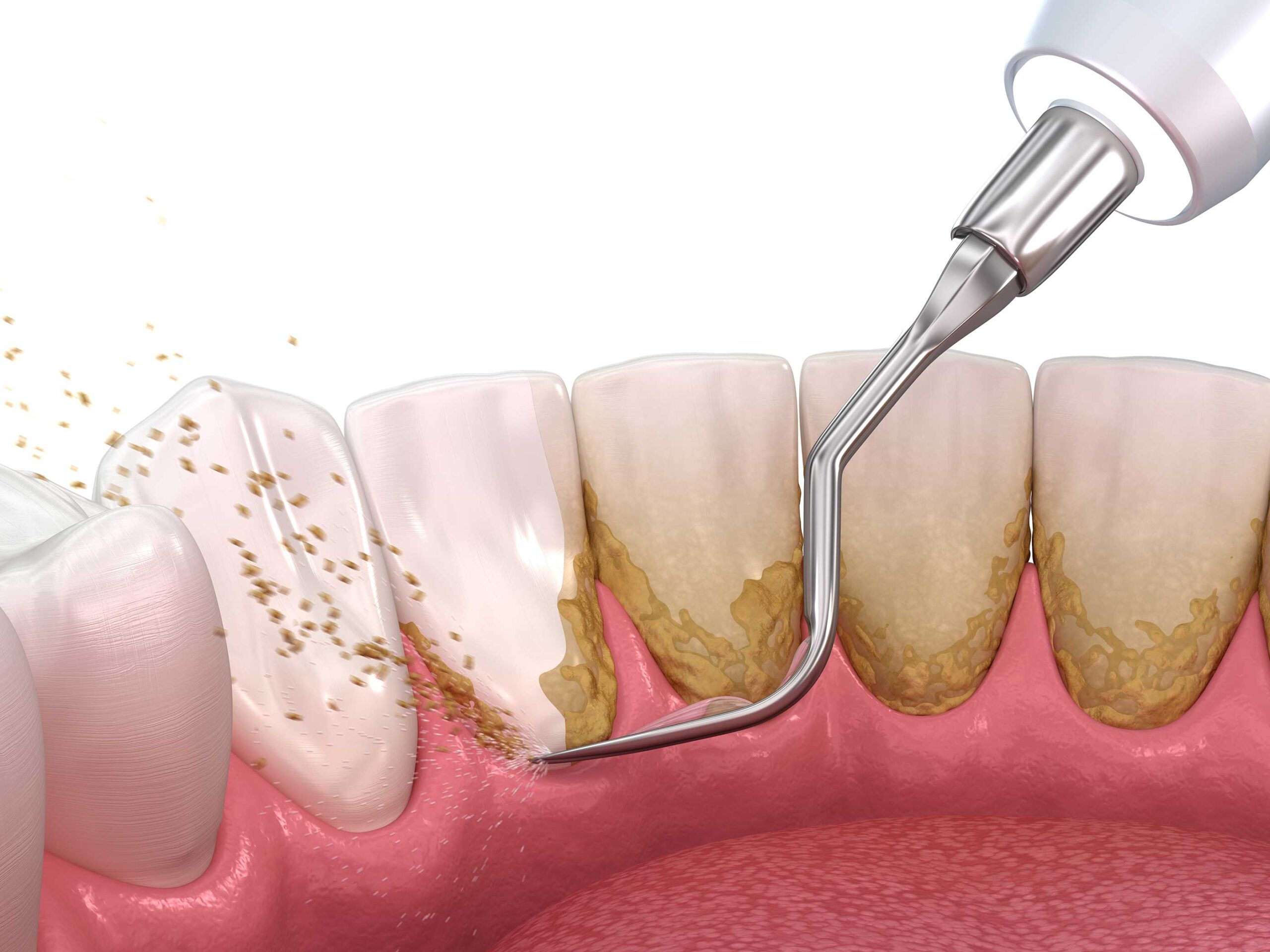 Dental Calculus: Key Facts Every Patient Should Know
